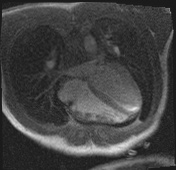 Active right ventricular cardiac sarcoidosis (Radiopaedia 55596-62100 Axial Dynamic perfusion scan MOCO 90).jpg