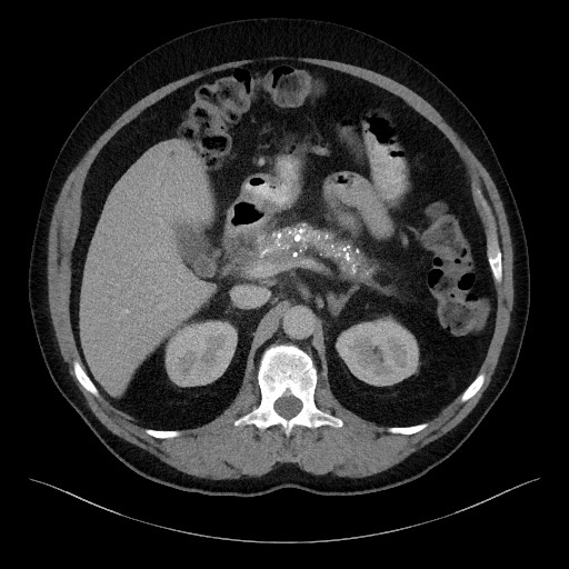 Acute-on-chronic pancreatitis (Radiopaedia 67286-76656 Axial C+ portal venous phase 26).jpg