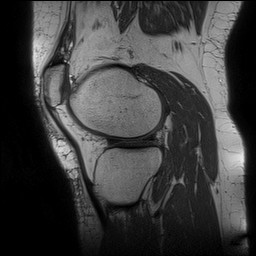 Acute-on-chronic transient lateral patellar dislocation with trochlear dysplasia (Radiopaedia 84099-99349 Sagittal PD 116).jpg