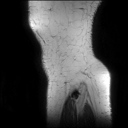 Acute-on-chronic transient lateral patellar dislocation with trochlear dysplasia (Radiopaedia 84099-99349 Sagittal PD 159).jpg