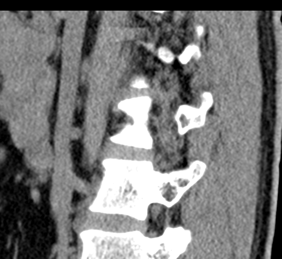 File:Acute L1 burst compression fracture (Radiopaedia 34430-35755 E 63).png