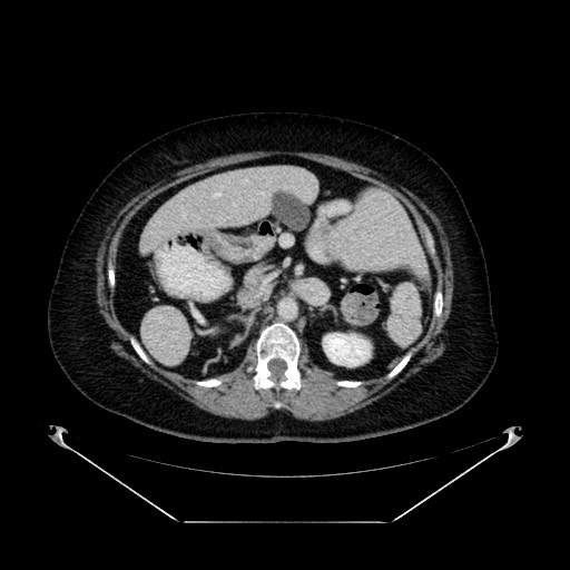 File:Acute appendicitis, heterotaxy syndrome (Radiopaedia 66884-76202 Axial 67).jpg