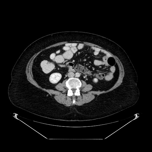 Acute appendicitis, heterotaxy syndrome (Radiopaedia 66884-76202 Axial C+ portal venous phase 71).jpg