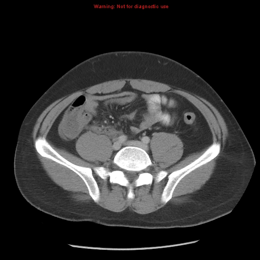 Acute appendicitis (Radiopaedia 10498-10973 Axial C+ portal venous phase 21).jpg