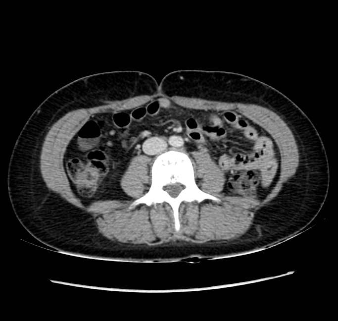 Acute appendicitis (Radiopaedia 22892-22918 Axial C+ portal venous phase 45).png