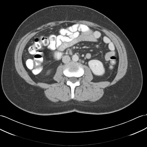 Acute appendicitis (Radiopaedia 30297-30934 Axial C+ portal venous phase 41).jpg