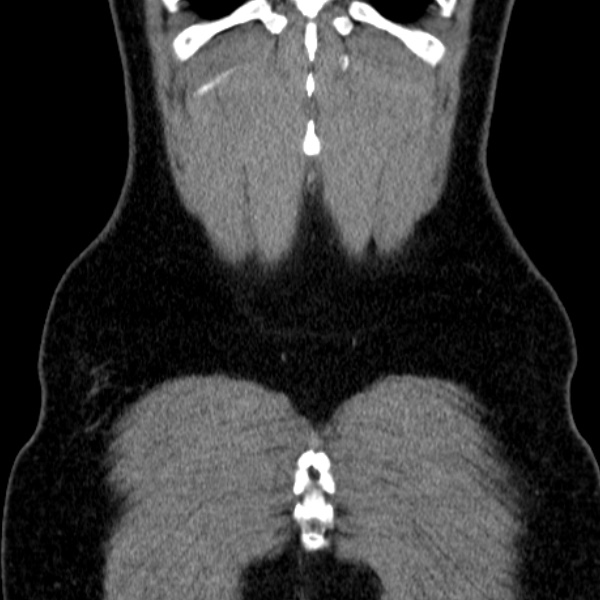 Acute appendicitis (Radiopaedia 38255-40270 Coronal C+ portal venous phase 82).jpg