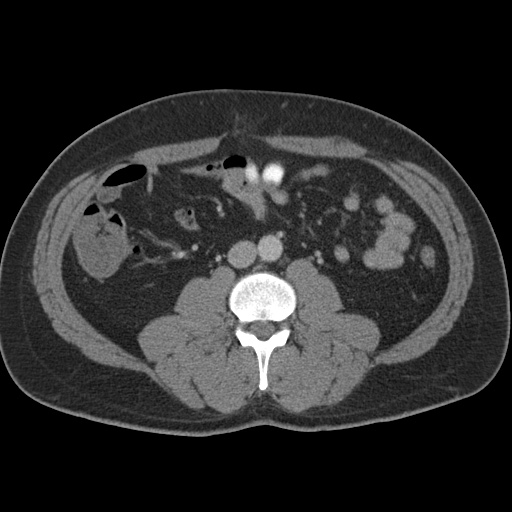 Acute appendicitis (Radiopaedia 48511-53463 Axial C+ portal venous phase 55).jpg