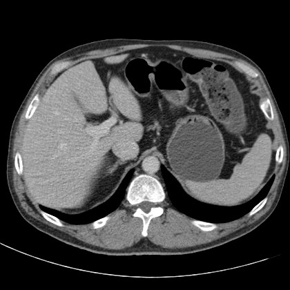 File:Acute appendicitis (Radiopaedia 66513-75790 Axial C+ portal venous phase 8).jpg
