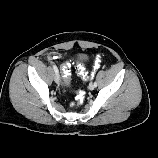 File:Acute appendicitis (Radiopaedia 77016-88960 Axial C+ portal venous phase 118).jpg