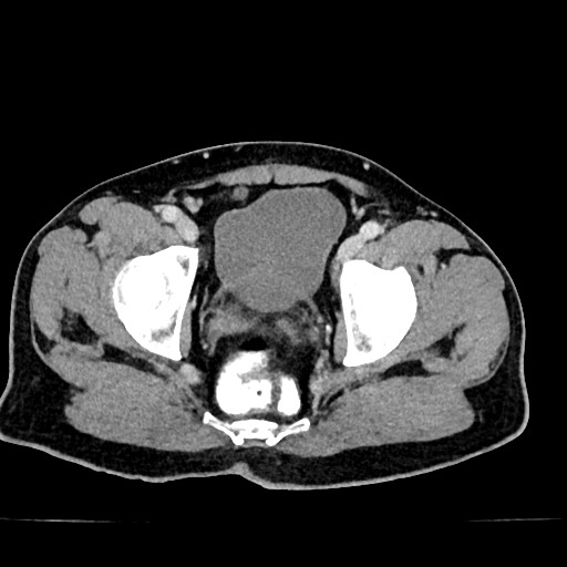 File:Acute appendicitis (Radiopaedia 77016-88960 Axial C+ portal venous phase 130).jpg