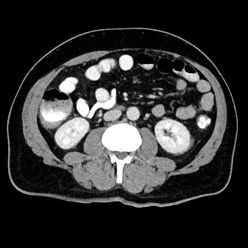 Acute appendicitis (Radiopaedia 77016-88960 Axial C+ portal venous phase 72).jpg