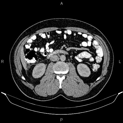 Acute appendicitis (Radiopaedia 84780-100240 Axial C+ portal venous phase 49).jpg