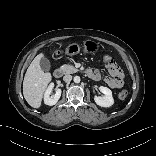 File:Acute appendicitis - large appendicoliths (Radiopaedia 61805-69820 Axial C+ portal venous phase 48).jpg
