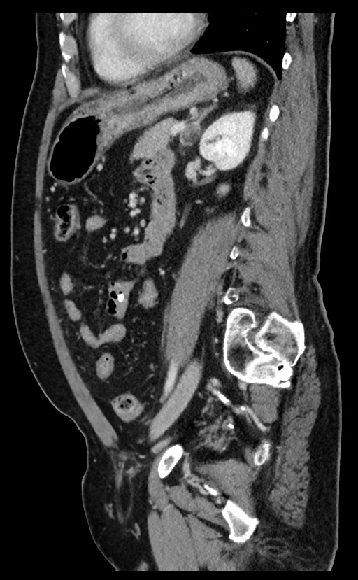 Acute appendicitis - large appendicoliths (Radiopaedia 61805-69820 Sagittal C+ portal venous phase 42).jpg