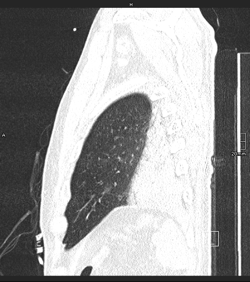 Acute aspiration pneumonitis (Radiopaedia 55642-62166 Sagittal lung window 12).jpg