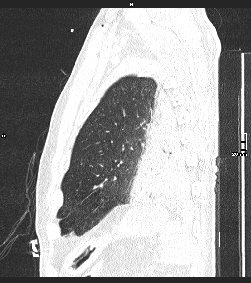 File:Acute aspiration pneumonitis (Radiopaedia 55642-62166 Sagittal lung window 17).jpg