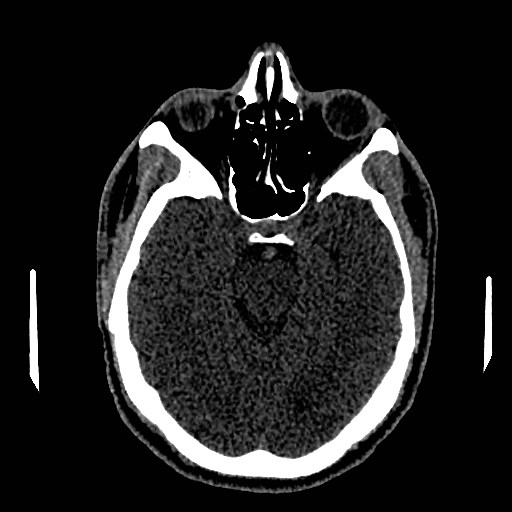 Acute basilar artery occlusion (Radiopaedia 43582-46985 Axial non-contrast 74).jpg