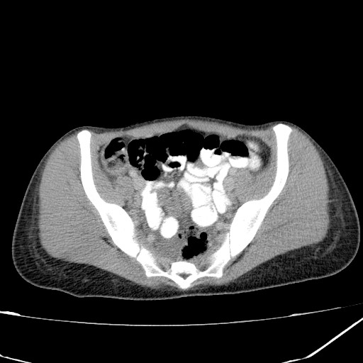 Acute bilateral pyelonephritis (Radiopaedia 74153-84969 Axial C+ portal venous phase 40).jpg