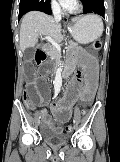 Acute bowel ischemia (Radiopaedia 87695-104114 Coronal C+ portal venous phase 189).jpg