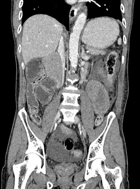 Acute bowel ischemia (Radiopaedia 87695-104114 Coronal C+ portal venous phase 225).jpg