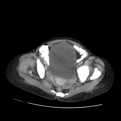 File:Acute calculous cholecystitis in patient with osteopetrosis (Radiopaedia 77871-90159 Axial C+ portal venous phase 70).jpg