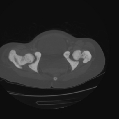 Acute calculous cholecystitis in patient with osteopetrosis (Radiopaedia 77871-90159 Axial bone window 48).jpg