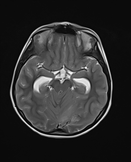 File:Acute cerebellar ataxia (Radiopaedia 61487-69446 Axial T2 9).jpg