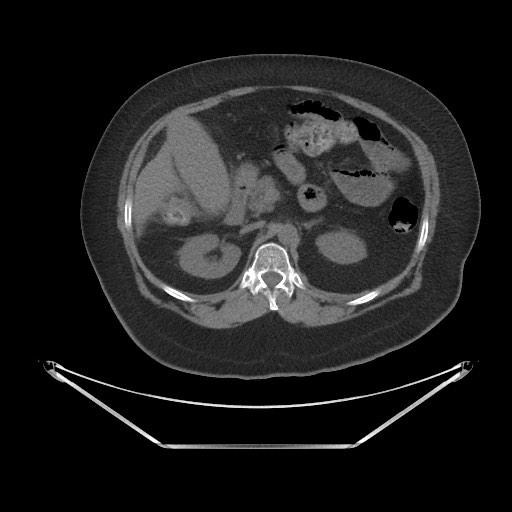 Acute cholecystitis with tensile fundus sign (Radiopaedia 71394-81723 Axial non-contrast 23).jpg