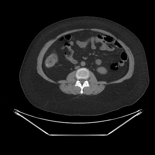 Acute cholecystitis with tensile fundus sign (Radiopaedia 71394-81723 Axial non-contrast 49).jpg