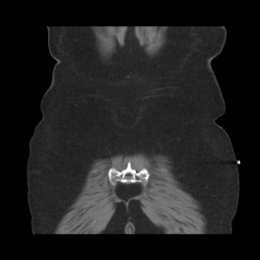 File:Acute cholecystitis with tensile fundus sign (Radiopaedia 71394-81723 Coronal non-contrast 110).jpg