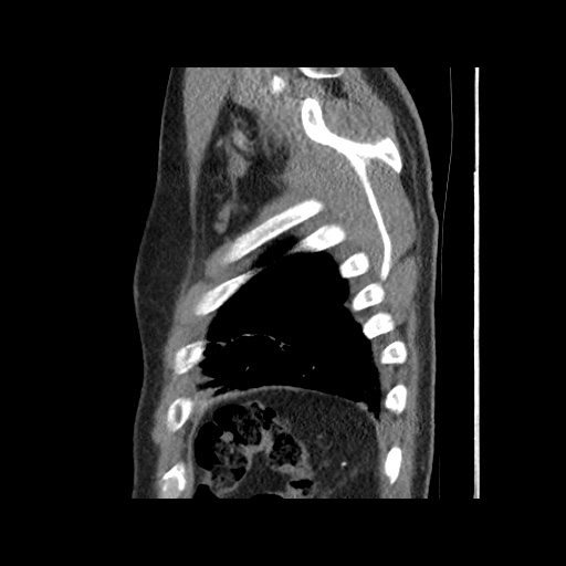 Acute epicardial fat necrosis (Radiopaedia 42327-45440 Sagittal C+ CTPA 62).jpg
