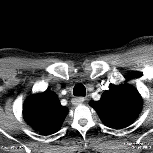 Acute epiglottitis (Radiopaedia 54375-60590 Axial C+ arterial phase 63).jpg