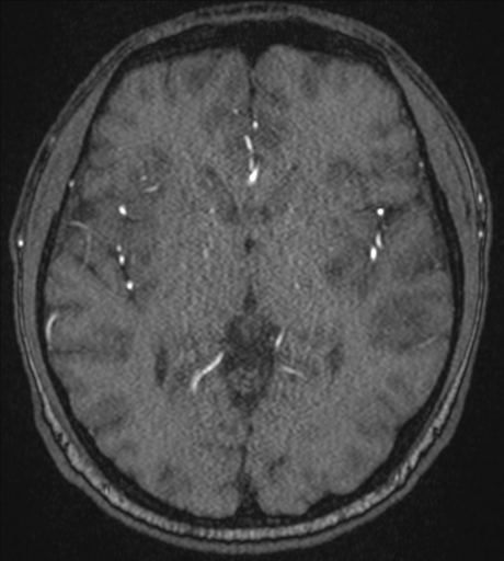 Acute left middle cerebral artery territory infarct with clot retrieval (Radiopaedia 47732-52433 Axial MRA 32).png