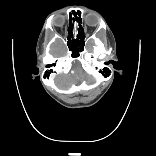 Acute longus colli calcific tendinitis (Radiopaedia 72495-83036 Axial C+ arterial phase 5).jpg