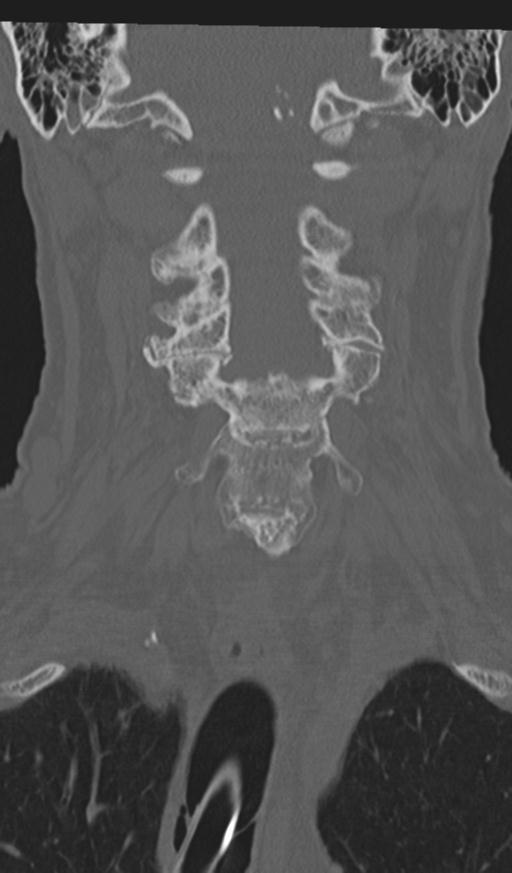 Acute on chronic subdural hematoma and thoracic vertebral injury in a multitrauma patient (Radiopaedia 31698-32619 Coronal bone window 26).jpg