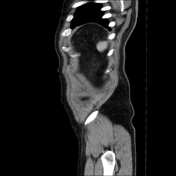 Acute pancreatitis (Radiopaedia 26663-26813 Sagittal C+ portal venous phase 69).jpg