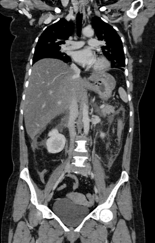 Acute pancreatitis (Radiopaedia 80007-93285 Coronal C+ portal venous phase 63).jpg
