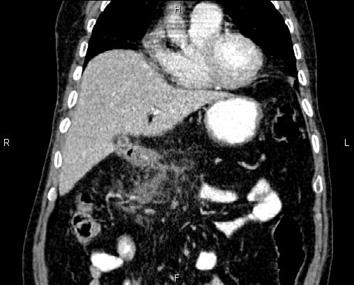 Acute pancreatitis (Radiopaedia 85146-100701 Coronal C+ portal venous phase 23).jpg