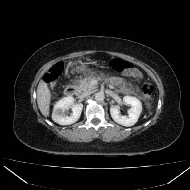 Acute pancreatitis - Balthazar C (Radiopaedia 26569-26714 Axial C+ portal venous phase 41).jpg