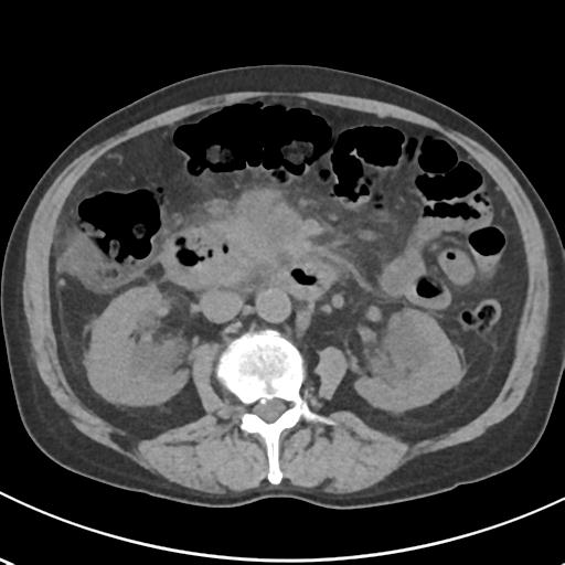 File:Acute pancreatitis and walled-off necrosis (Radiopaedia 29888-30404 Axial non-contrast 35).jpg