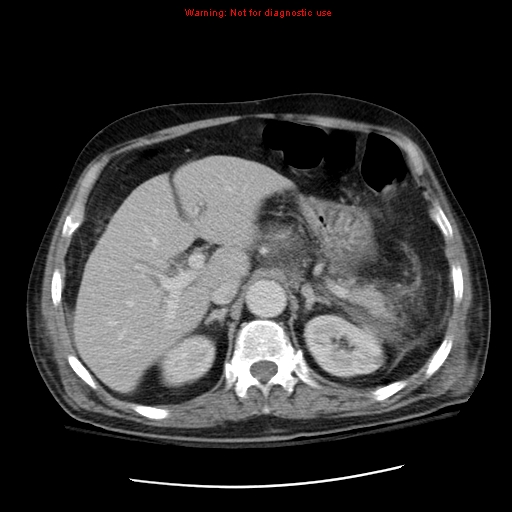 File:Acute pancreatitis with incidental pancreatic lipoma (Radiopaedia 10190-10730 Axial C+ portal venous phase 18).jpg