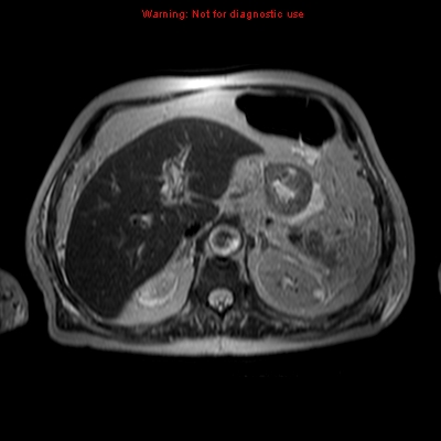File:Acute pancreatitis with incidental pancreatic lipoma (Radiopaedia 10190-10732 Axial T2 16).jpg