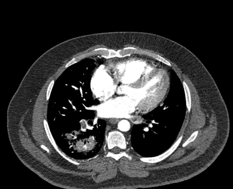 Acute pulmonary embolism with pulmonary infarcts (Radiopaedia 77688-89908 Axial C+ CTPA 38).jpg