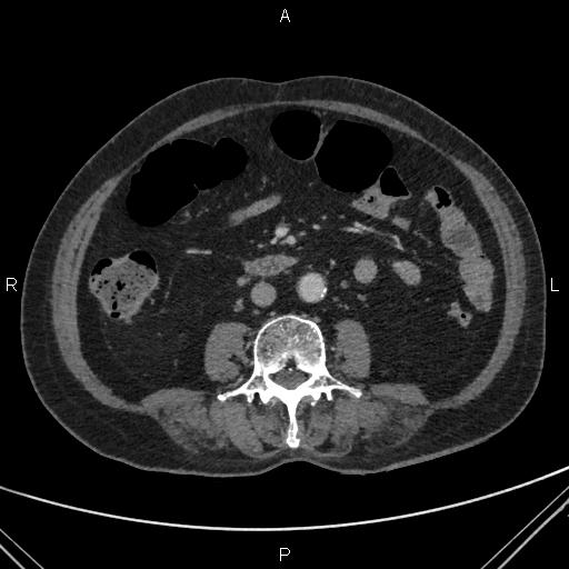 File:Acute renal artery occlusion (Radiopaedia 86586-102682 Axial C+ portal venous phase 48).jpg