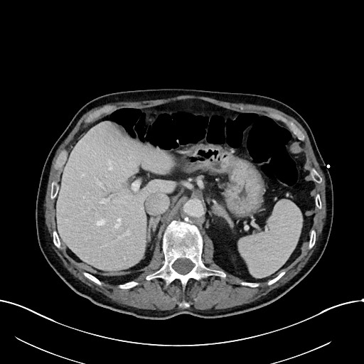 Acute renal infarction (Radiopaedia 59375-66736 Axial C+ portal venous phase 24).jpg