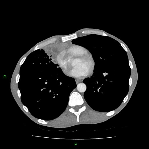 File:Acute right lung abscess (Radiopaedia 34806-36258 Axial C+ arterial phase 122).jpg
