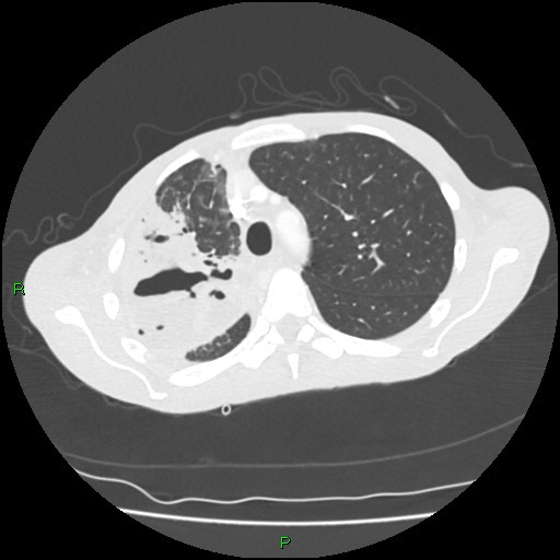 Acute right lung abscess (Radiopaedia 34806-36258 Axial lung window 48).jpg