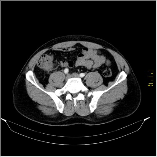 Acute right sided diverticulitis (Radiopaedia 65249-74268 Axial C+ portal venous phase 55).JPG