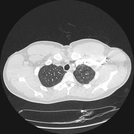 Acute segmental pulmonary emboli and pulmonary infarction (Radiopaedia 62264-70444 Axial lung window 24).jpg